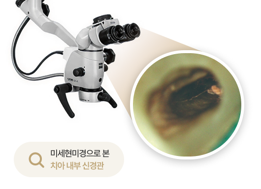 고난도 신경치료