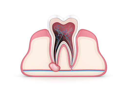 고난도 신경치료