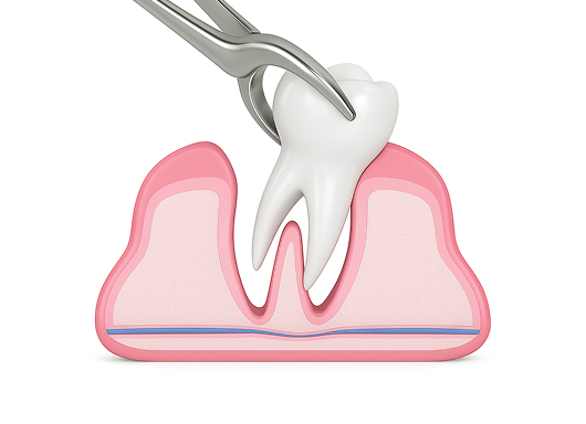 고난도 신경치료
